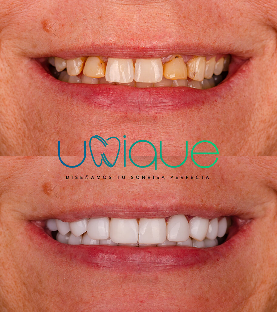 Composite veneer transformation — Cassandra