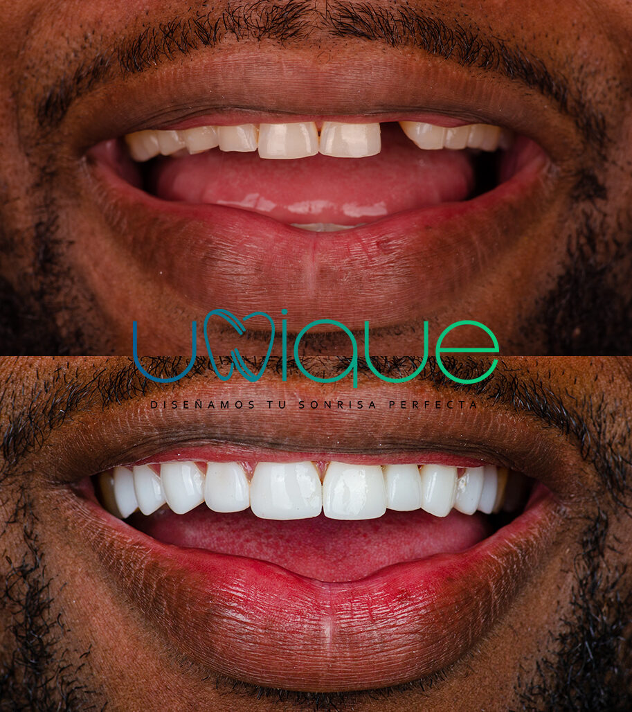 Composite veneer transformation — Esan