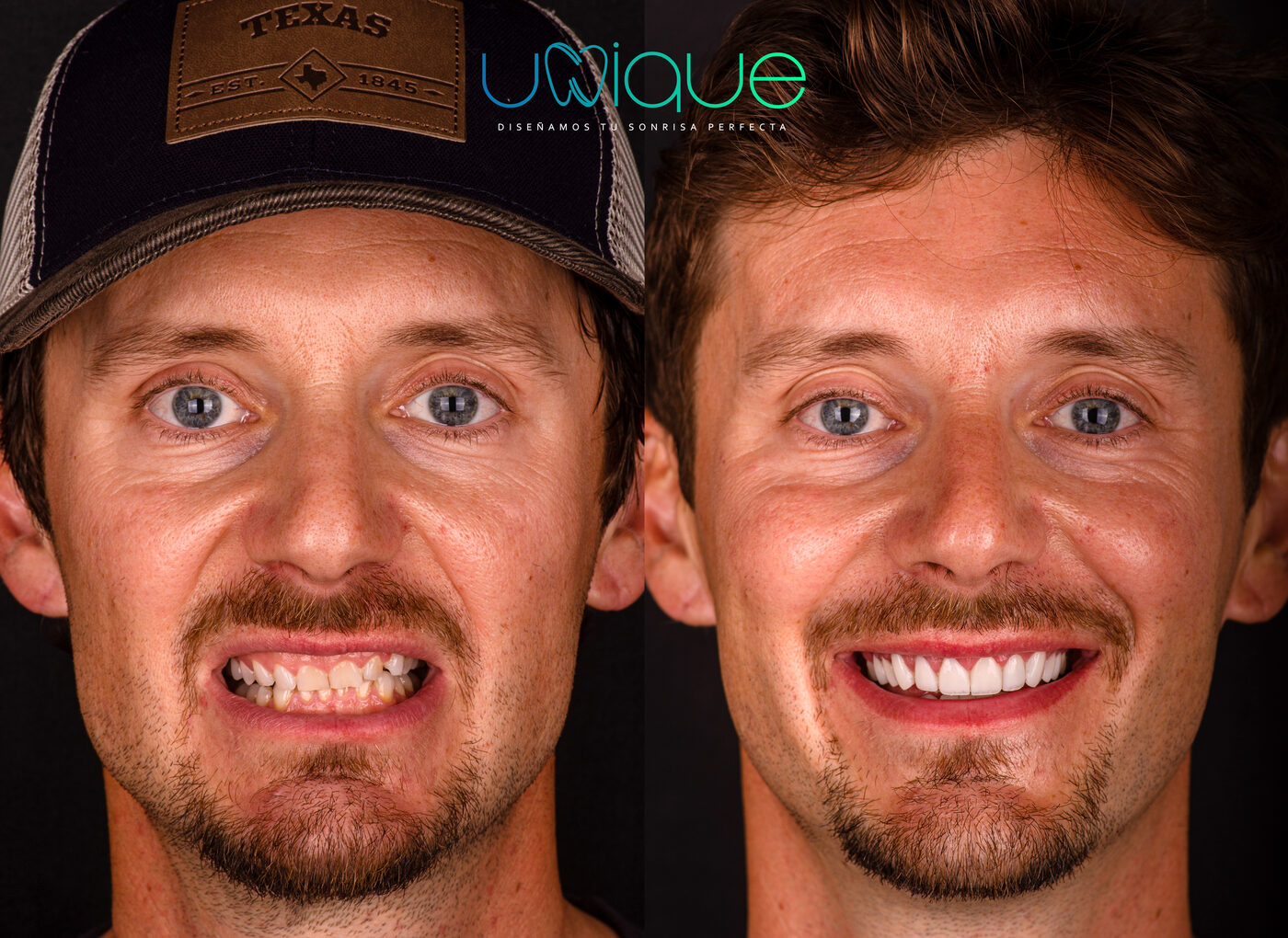 Patient after porcelain veneer treatment in Cancun