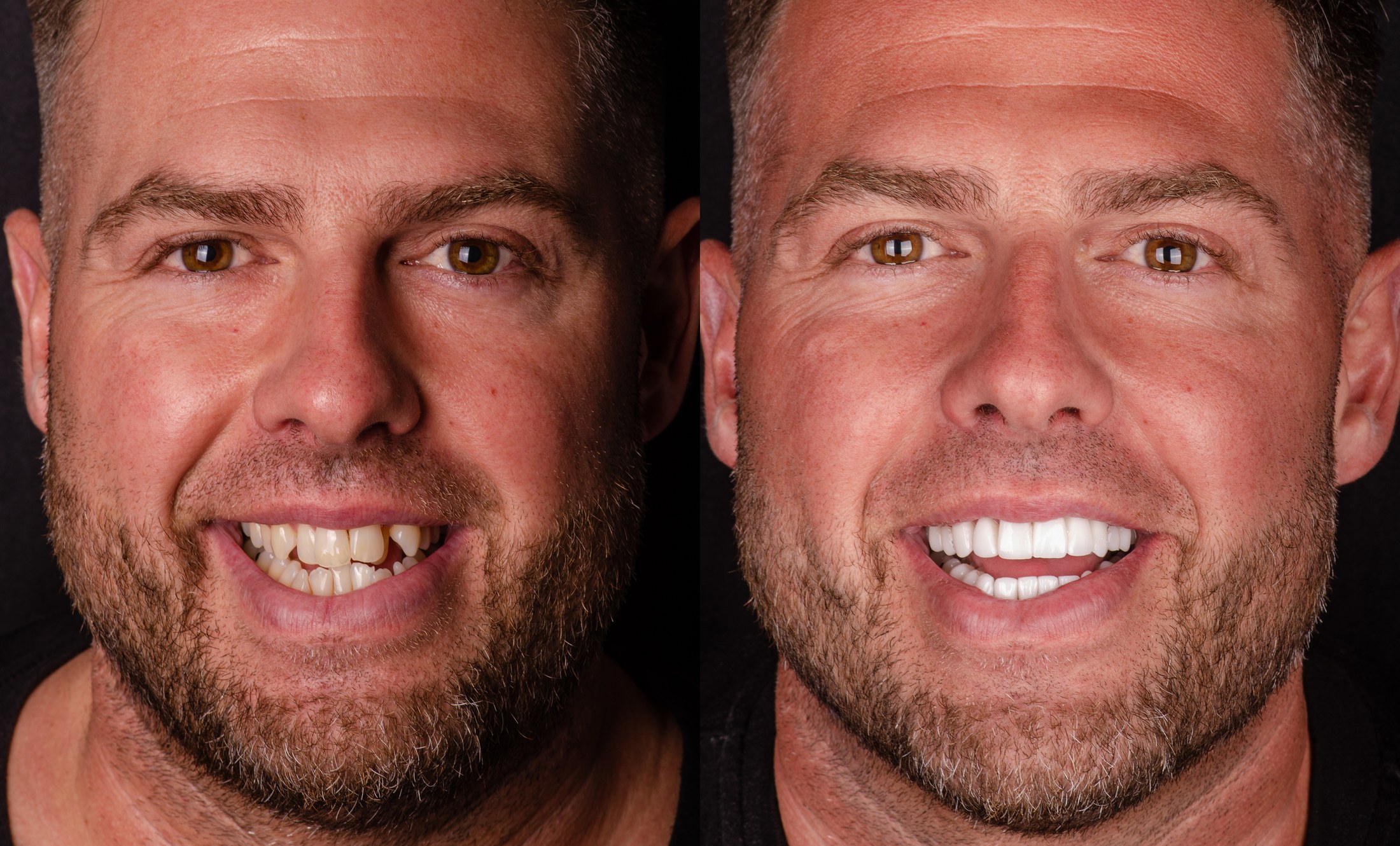 Porcelain veneer transformation