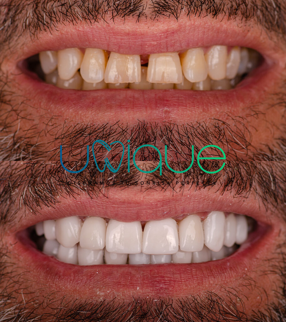 Porcelain veneer transformation