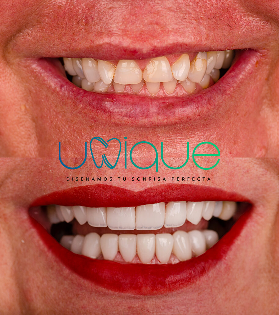 Porcelain veneer transformation — Anneta